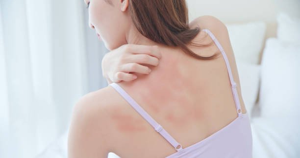 A woman scratches her back in a spot that is red and inflamed.